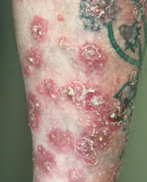 Example of Psoriasis showing red flaking skin on leg